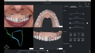 Smilefy 42 Demo  3D Smile Simulation [upl. by Millisent]