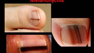 Melanoma Melanonychia  What is it [upl. by Kinelski]