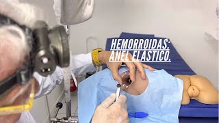 Hemorroidas internas tratadas anel elástico nessa simulação proctologista Dr Paulo Branco [upl. by Kelsi]