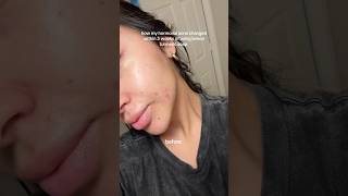 How my hormonal acne changes within 3 weeks of using turmeric soap skincare acnetreatment [upl. by Imre]