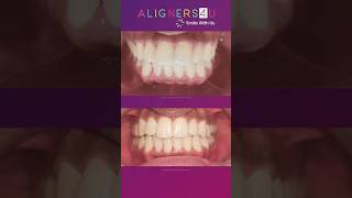 quotAligners4u Your Path to a Perfect Smile 😁quot  Clear Aligners  Invisible Braces  Hyderabad [upl. by Aicilra]