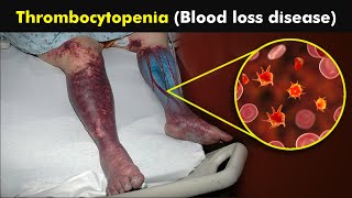 What Causes Low Platelets in our blood  Thrombocytopenia Disease 3D Animation [upl. by Kerin604]