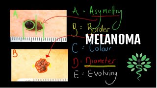 Melanoma  Symptoms signs diagnosis and management [upl. by Nelloc868]