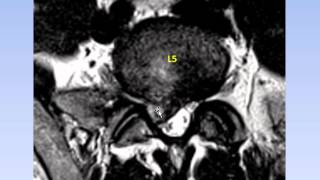 Dr Gillard Lectures on Lumbar Disc Herniation  Protrusion Part II of II [upl. by Islek]