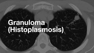 Classic Case Granuloma from Histoplasmosis [upl. by Sapphire]