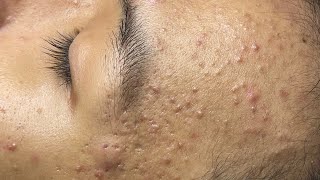 ACNE TREATMENT VU QUYNH MI  Blackheads Chin amp Nose Of Teen 2024 [upl. by Eerac]