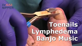 Nails Lymphedema and Banjo Music  FEETure Friday 👩🏻‍⚕️🦶🚶🏃 [upl. by Anat]