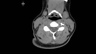 Mediastinal duplication cyst [upl. by Pytlik]