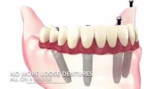 All on 4 Implants  Nuffield Dental Clinics Singapore [upl. by Sigismond673]