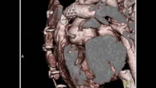 Cardiac Congenital heart disease with stent in pulmonary arteries 1 of 8 [upl. by Kubiak]