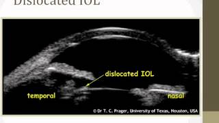 New technologies in Glaucoma UBM [upl. by Enner622]