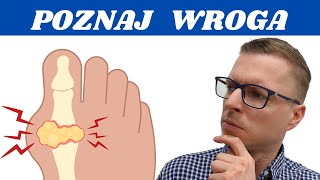 Dna Moczanowa  Podagra  Wszystko Co Musisz Wiedzieć Krótko i Na Temat [upl. by Serge]