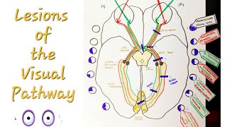 Lesions of the Visual Pathway  Optic Nerve and pathway lesions [upl. by Zysk]