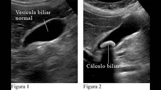 VESÍCULA BILIAR VALORACIÓN ECOGRÁFICA [upl. by Ehc284]
