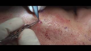 Acne Scar Revision Part 04 More Subcision Technique by Dr Young [upl. by Analad422]