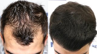 FUE Hair Transplant 2500 Grafts NW III A By Dr Juan Couto  FUEXPERT CLINIC Madrid Spain [upl. by Aimac]