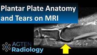 How to Assess Plantar Plate Anatomy and Tears on MRI [upl. by Henarat586]