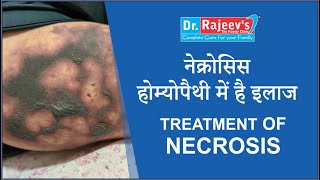 Homeopathic Medicine and Treatment for Necrosis Homoeopathic best Doctor for Necrosis [upl. by Reese865]