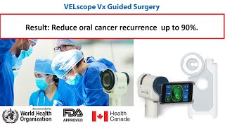 VELscope Guided Oral Cancer Surgery Best Treatment Outcomes amp Survival Rate SurgeonMustHave 2021 [upl. by Nosrak575]