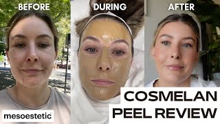 COSMELAN DEPIGMENTATION PEEL  chemical peel for pigmentation  dark spots [upl. by Chevy]