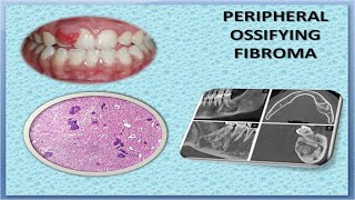 Peripheral Ossifying Fibroma [upl. by Michaud332]