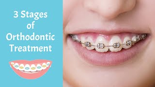 The 3 Stages of Orthodontic Treatment [upl. by Nagel]