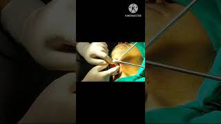 ગળાની રસોળી નું ઓપરેશન गले में गठानthyroglossal cyst removal under local anaesthesiatruptient [upl. by Yluj722]