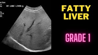 Fatty liver grade 1  mild  Ultrasound Case [upl. by Attelra]