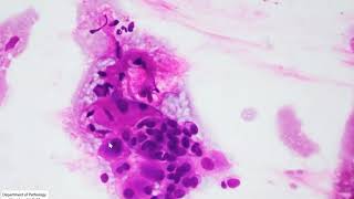 Cytology of Low grade mucoepidermoid carcinoma [upl. by Adnauq760]