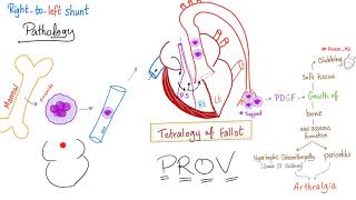 The Megakaryocytes Clinical Significance Tetralogy of Fallot Nail Clubbing Cardiology [upl. by Hosfmann]