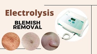 Advanced Electrolysis to remove thread veins milia skin tags cherry angiomas moles and more [upl. by Ahsoym]