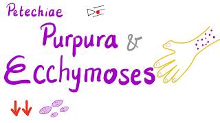 Petechiae Purpura and Ecchymoses [upl. by Pros506]