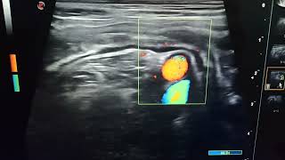 Échographie abdominale Maladie de crohn [upl. by Mandal]