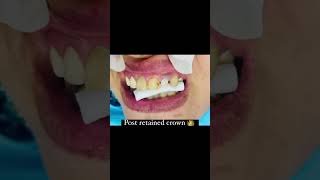 dentistry endodontist endodoncia conservative dentist post fixedcrownrestoration [upl. by Enytnoel538]