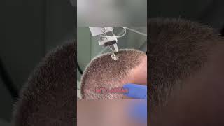 This New Gun Fights Hair Loss Better Than Ever [upl. by Amikahs]