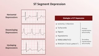 Do You Know Your T Waves on ECG [upl. by Nylirrej369]