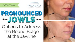 The Different Causes of Jowls Along the Jawline and their Customized Treatments [upl. by Annoerb]