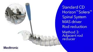 CD Horizon™ Solera™ Spinal System  Dual Rod MultiAxial Screw DRMAS amp Variable Angle Domino VAD [upl. by Kelula]