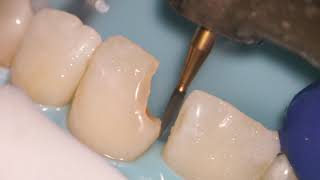 Teeth Bonding  Front tooth filling EXPLAINED [upl. by Ocirrej]