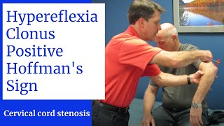 Hyperreflexia Clonus Positive Hoffmans Sign Central Cervical Spine Stenosis [upl. by Dragoon94]