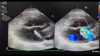 Endocardial Cushion Defect  Rastelli type C [upl. by Grand122]