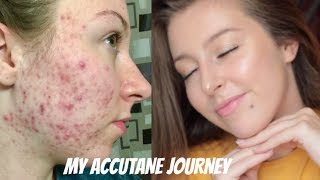 MY ISOTRETINOIN ACCUTANE JOURNEY  BEFORE AND AFTER PHOTOS [upl. by Anilegna]