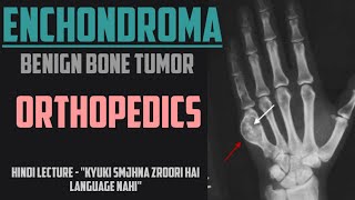 Enchondroma  Benign Bone Tumor  Orthopedics 9  NEET PG [upl. by Iahc835]