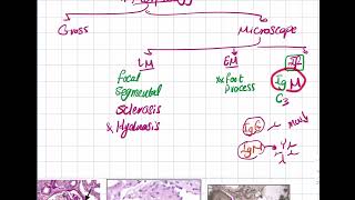 Focal Segmental amp Membranoproliferative GN [upl. by Magill]