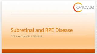 OCT Interpretation Session 5 Subretinal and RPE Disease [upl. by Alauqahs]