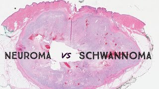 Neuroma vs Schwannoma palisaded encapsulated neuroma nerve sheath tumor dermpath dermatology [upl. by Dduj129]