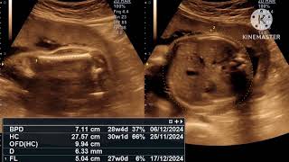 Fetal ultrasound at 28 weeks [upl. by Alicec]