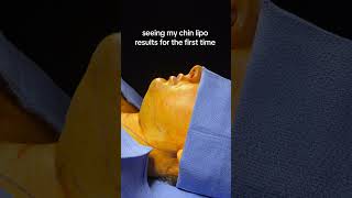 CHIN LIPO BEFORE amp AFTER 🤯 doublechinlipo glowup beforeandafter chinlipo chinliposuction [upl. by Allard]