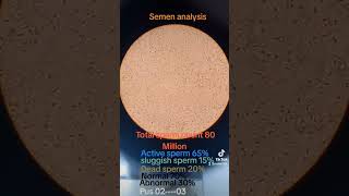 Semen analysis microscope examinationsperm countsemen RE semen analysis test report shorts [upl. by Akienahs449]