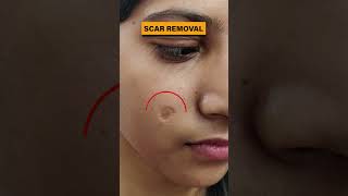 Scar Removal Treatment in Delhi  Scar removal results before and after scar scarremoval scars [upl. by Behre]